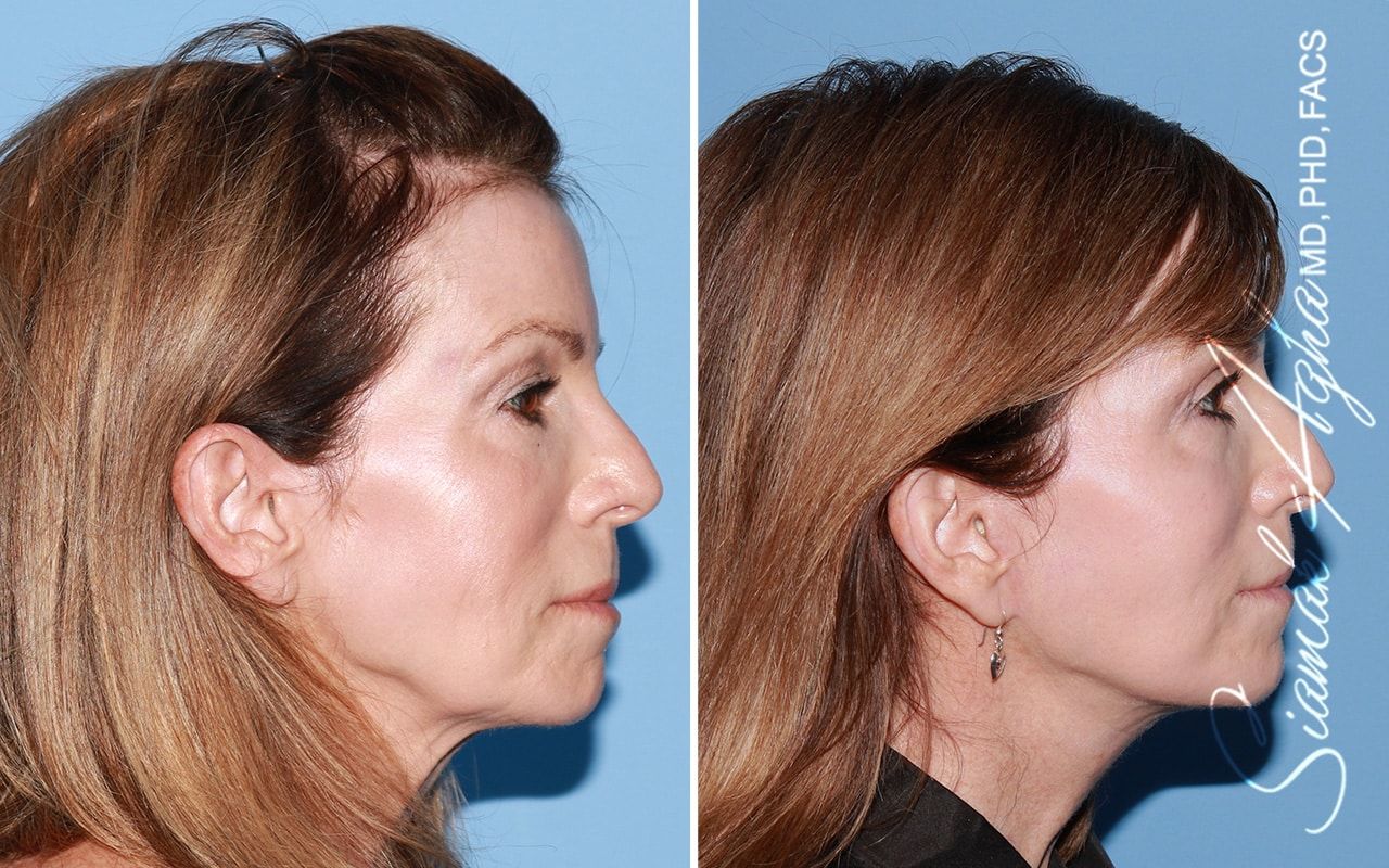 Facelift Before & After