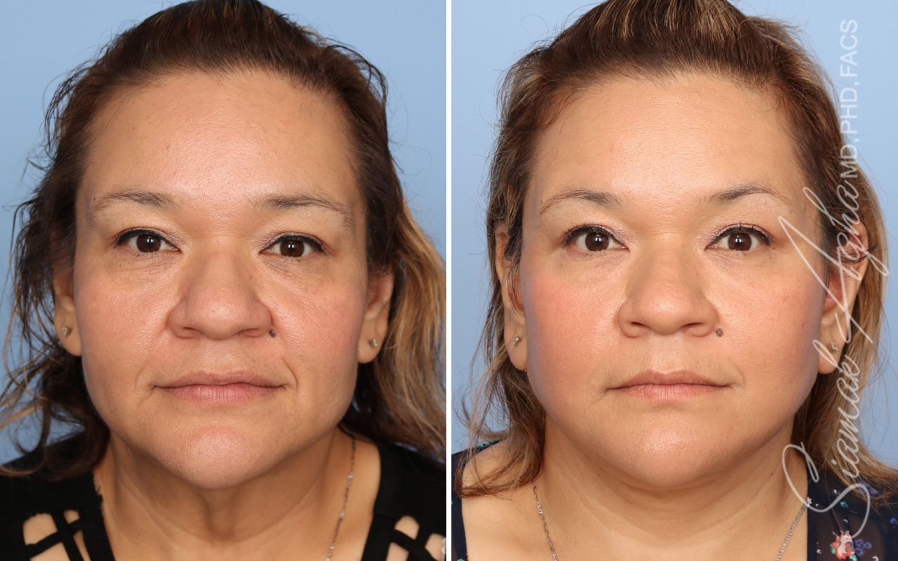 Facelift Before & After