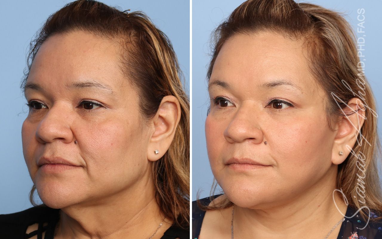 Facelift Before & After
