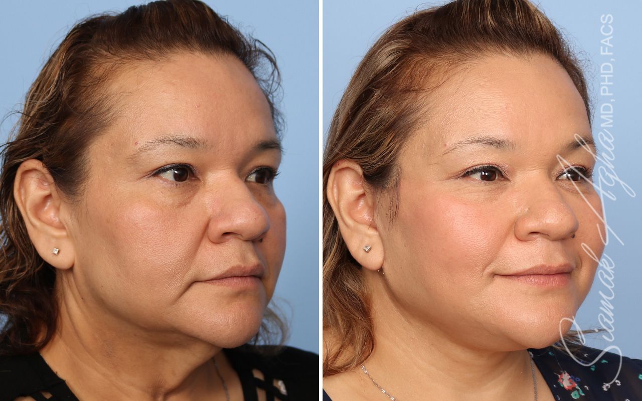 Facelift Before & After