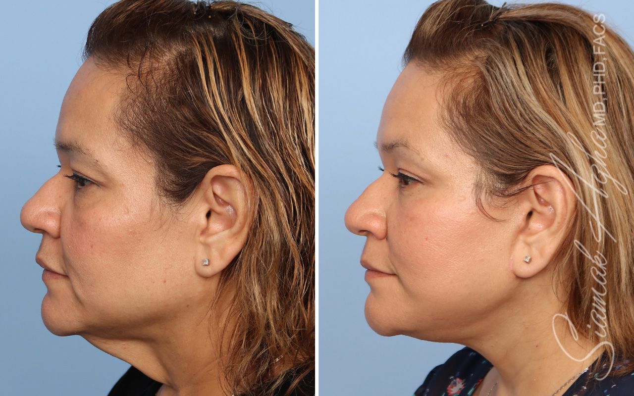 Facelift Before & After