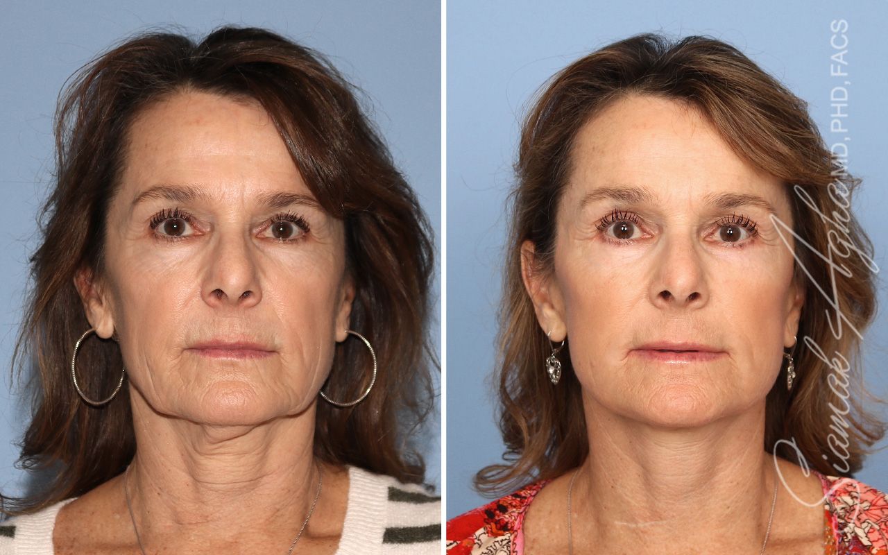 Facelift Before & After