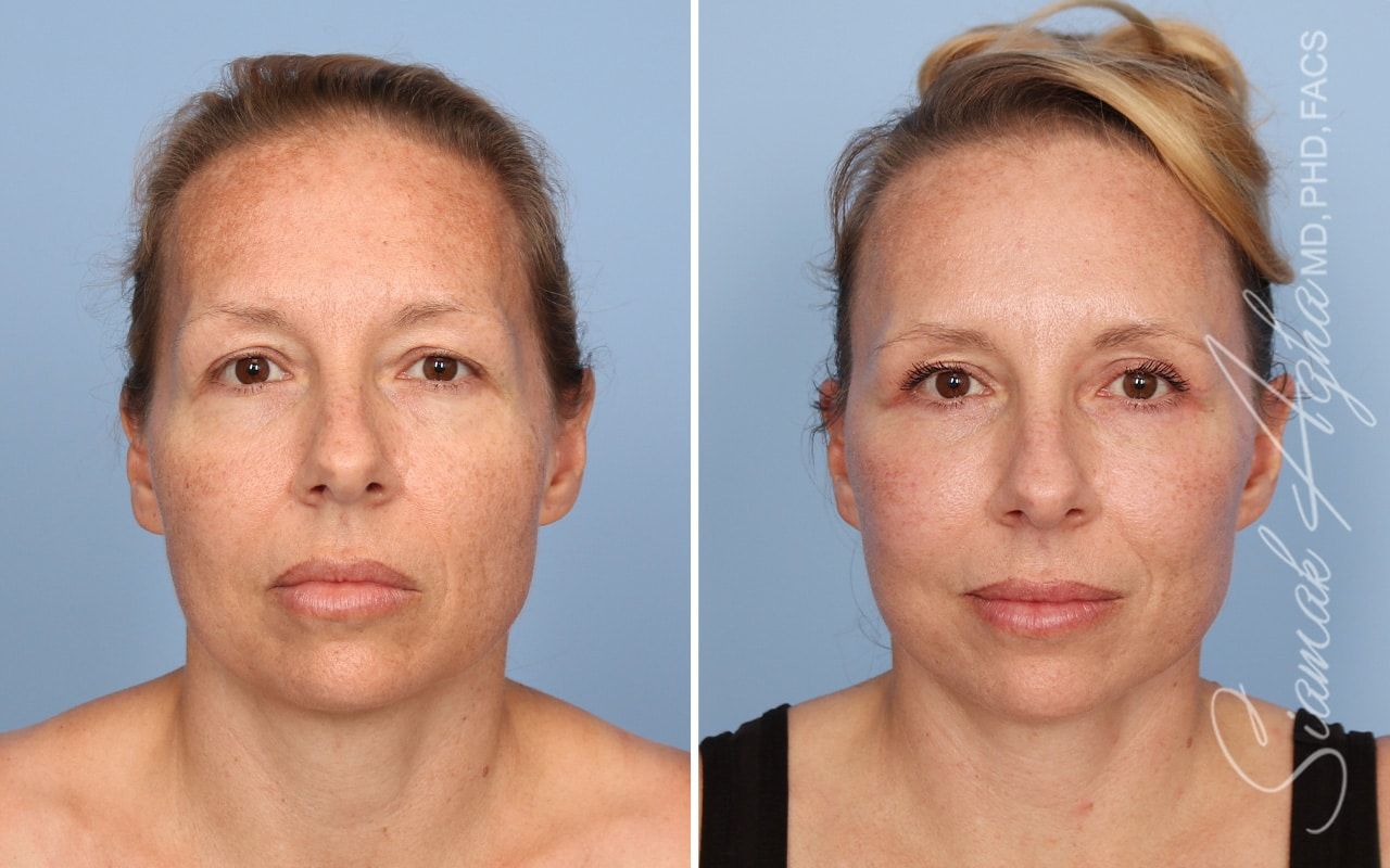 Facelift Before & After