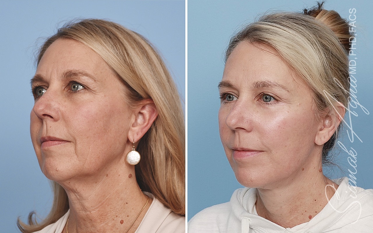 Facelift Before & After