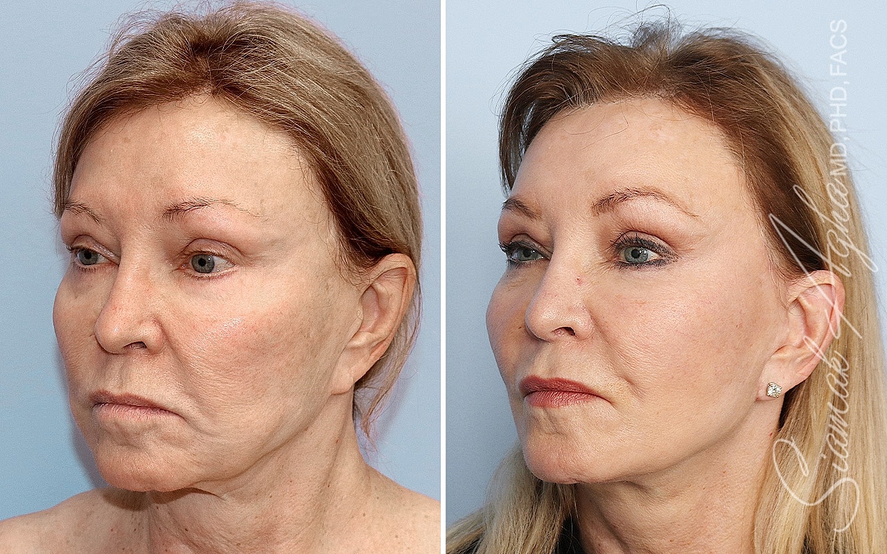 Facelift Before & After