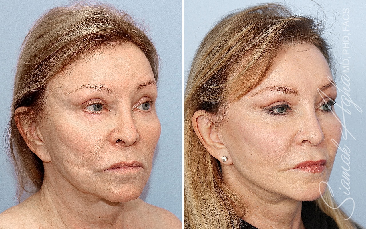 Facelift Before & After