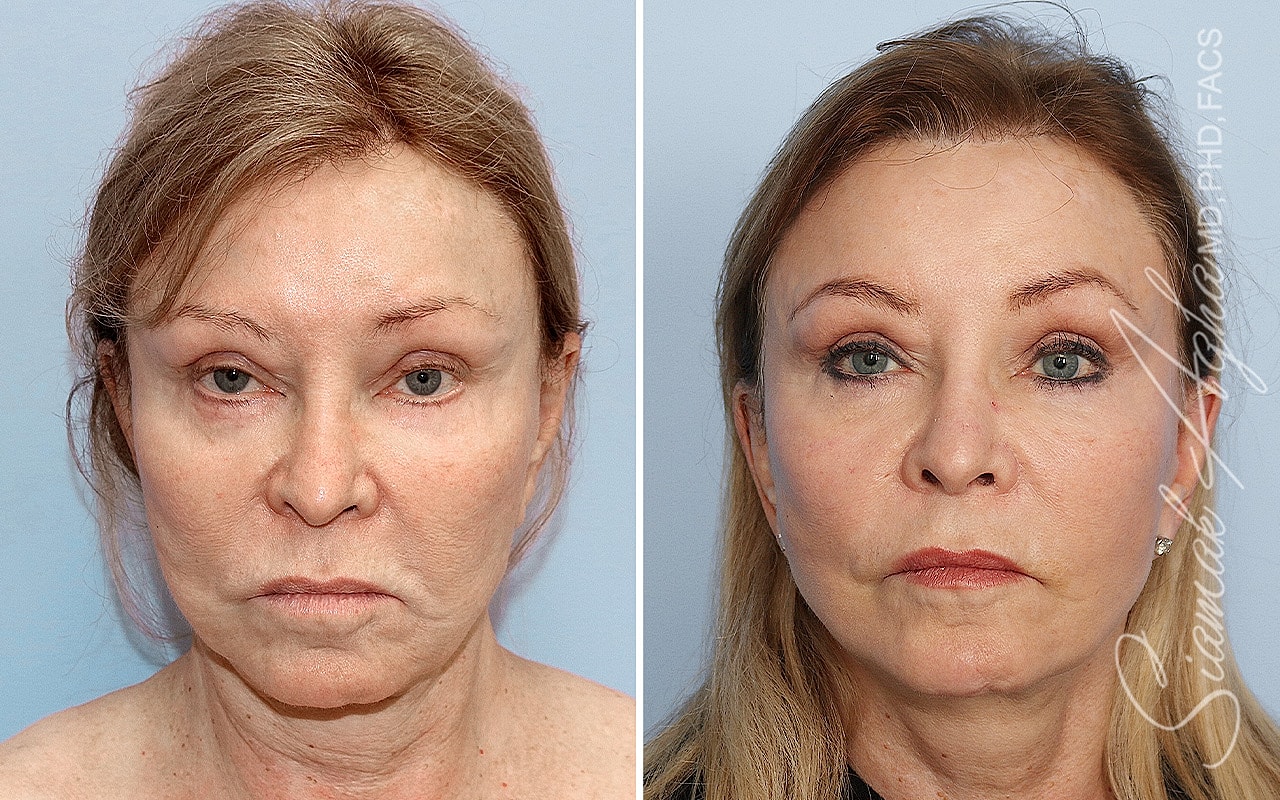 Facelift Before & After