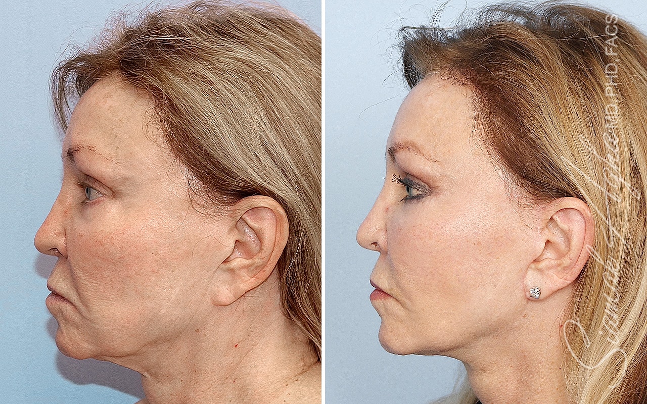 Facelift Before & After