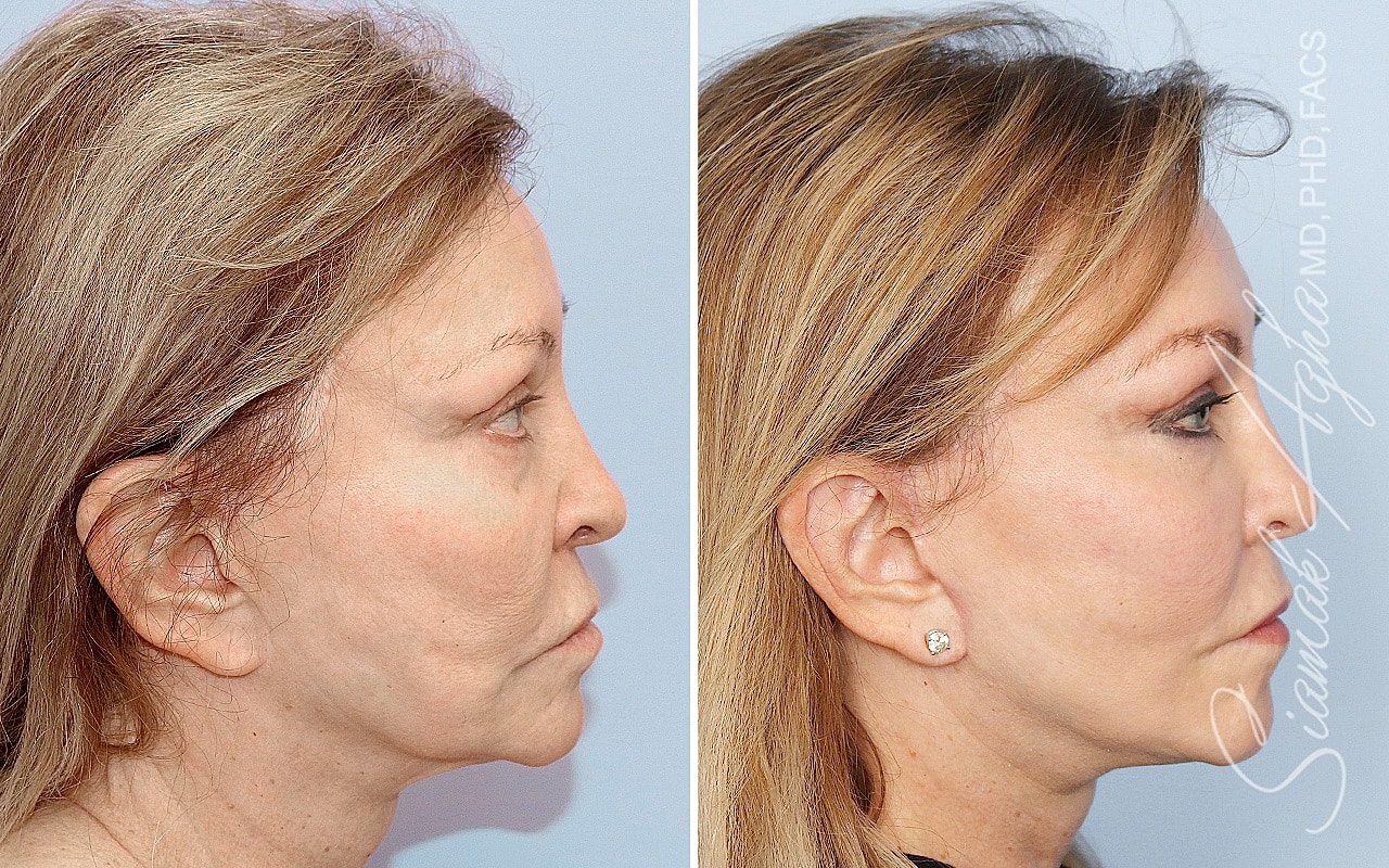 Facelift Before & After