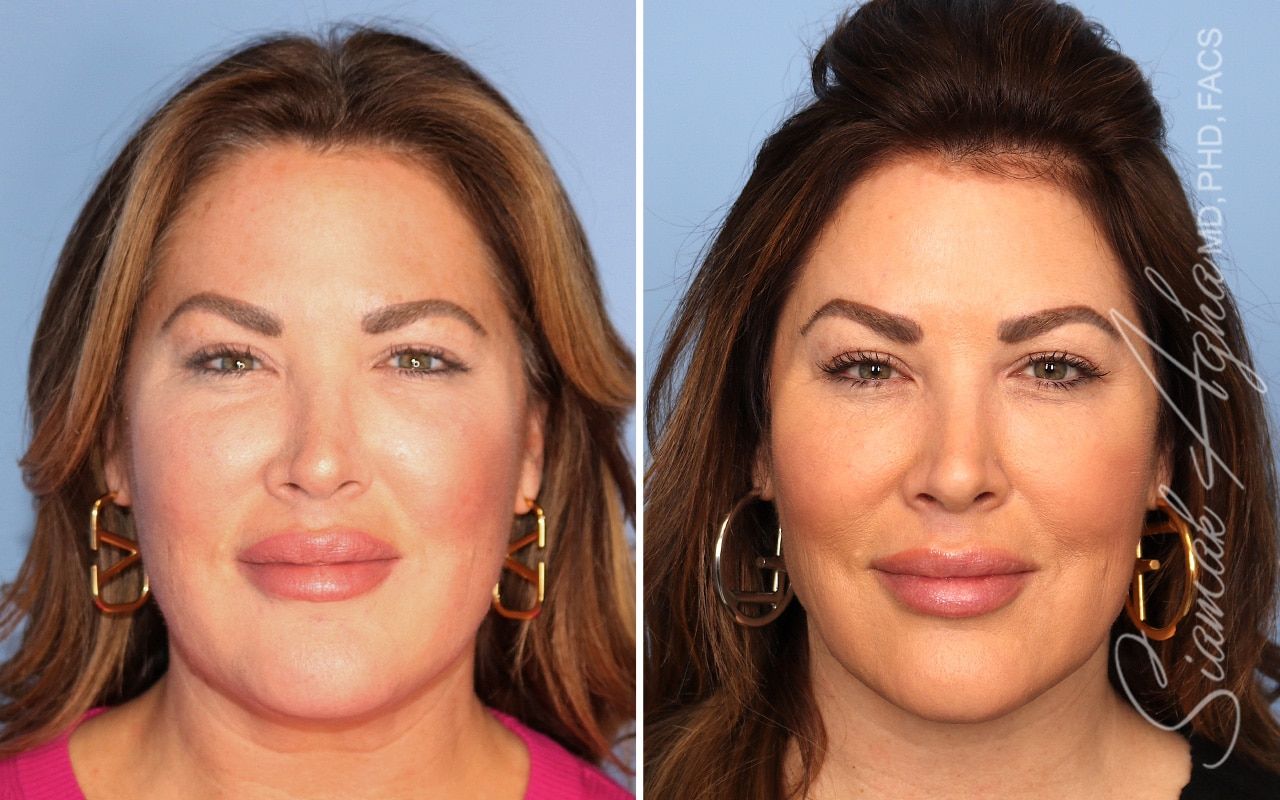 Facelift Before & After