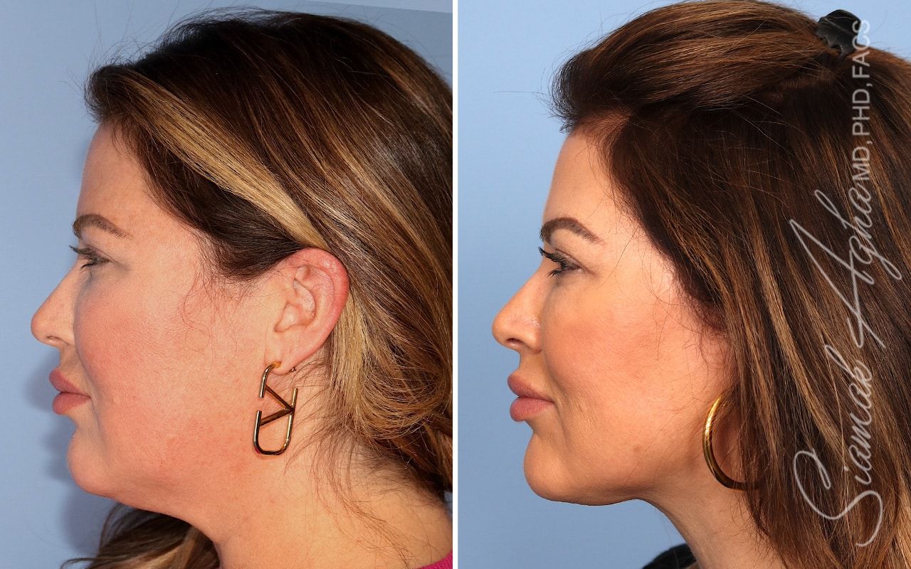 Facelift Before & After