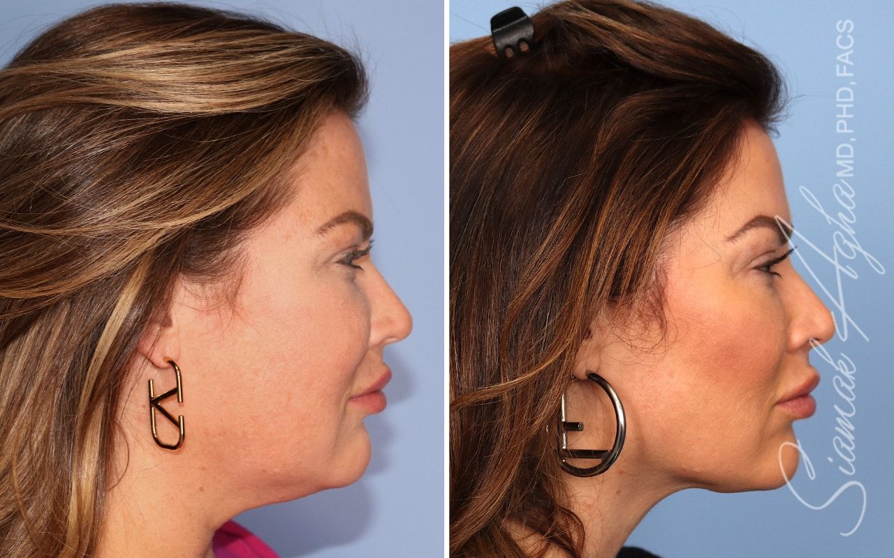 Facelift Before & After