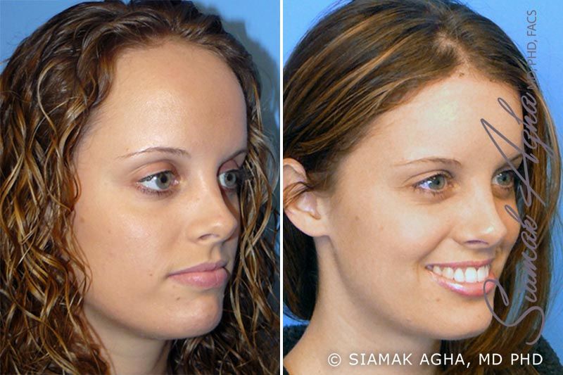 Forehead Reduction Before & After