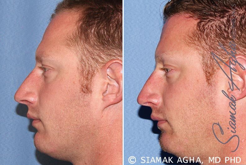 Forehead Reduction Before & After