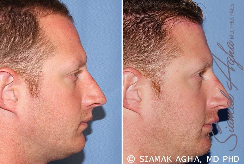 Forehead Reduction Before & After
