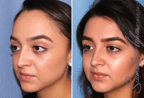 Forehead Reduction Before & After