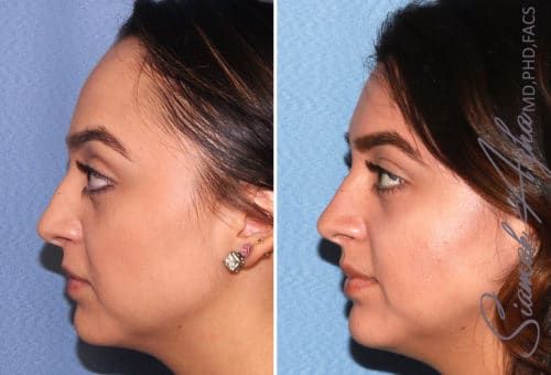 Forehead Reduction Before & After
