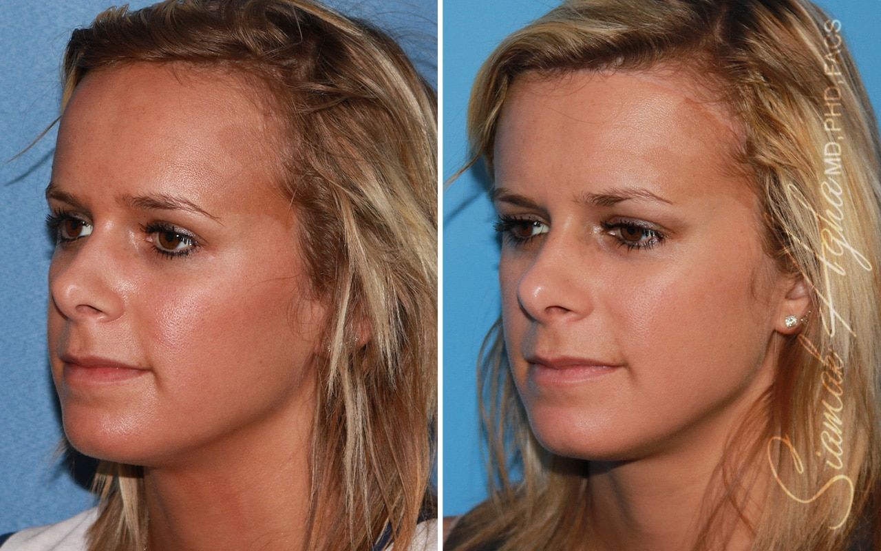 Forehead Reduction Before & After