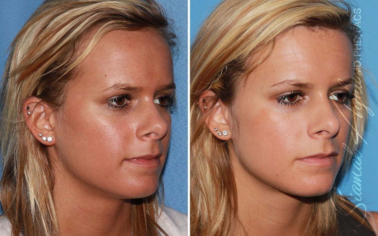 Forehead Reduction Before & After