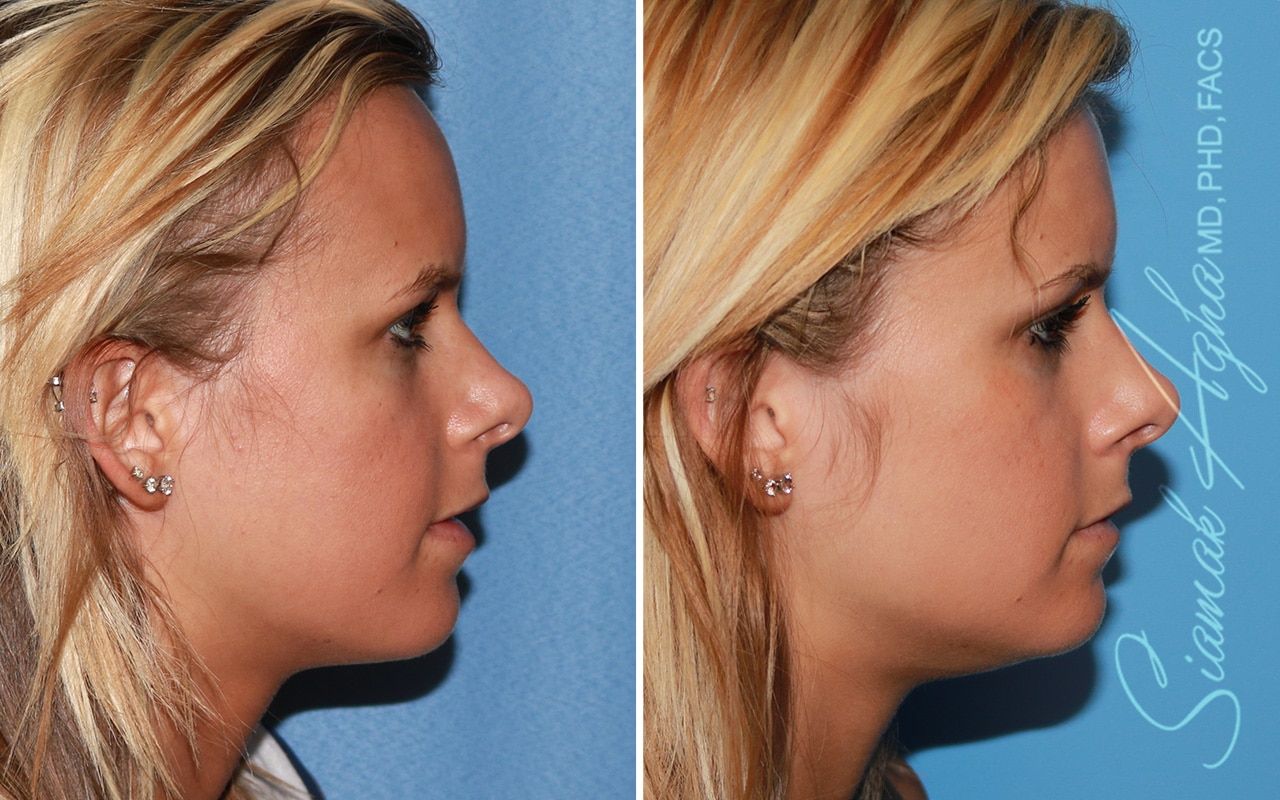 Forehead Reduction Before & After