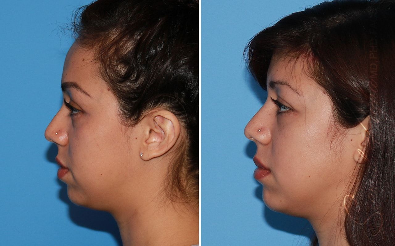 Forehead Reduction Before & After