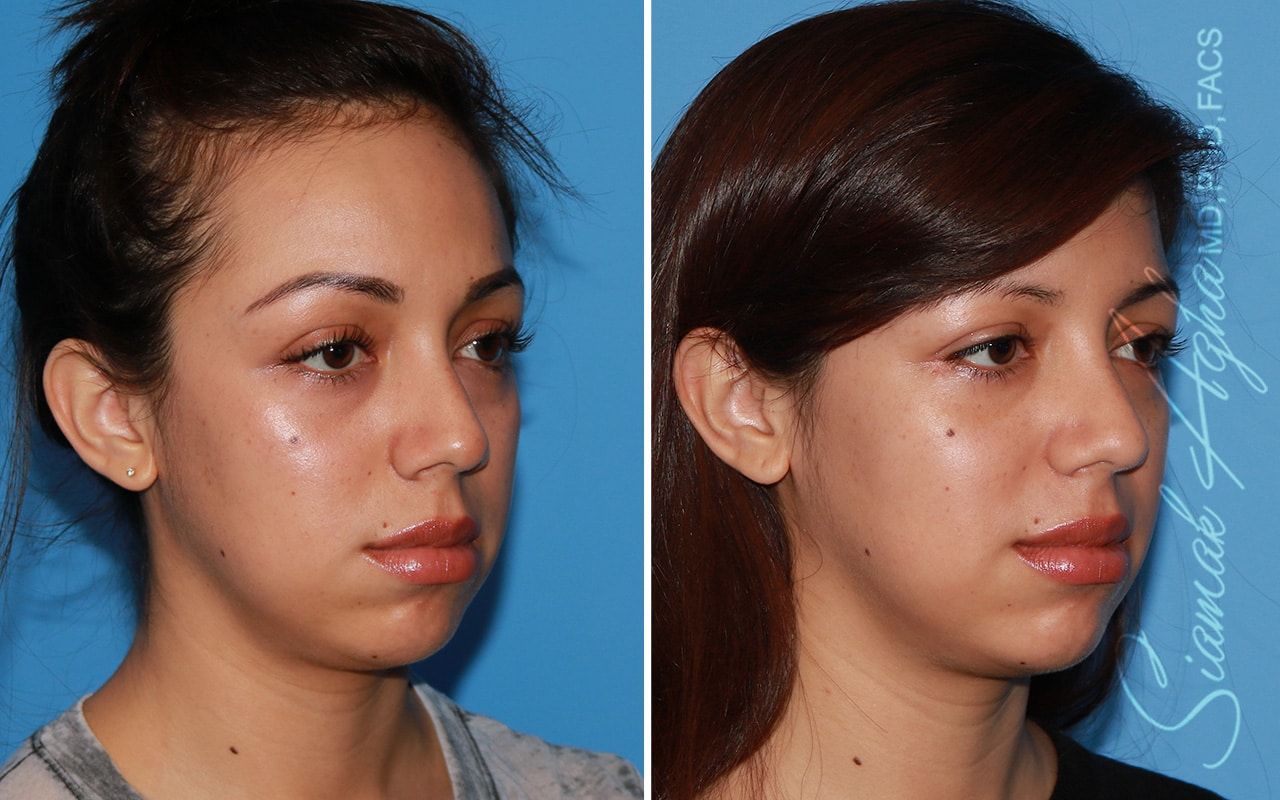 Forehead Reduction Before & After