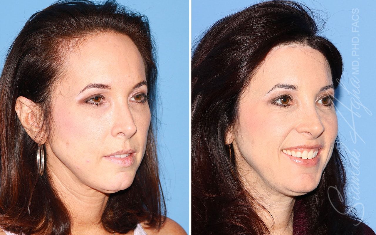 Forehead Reduction Before & After