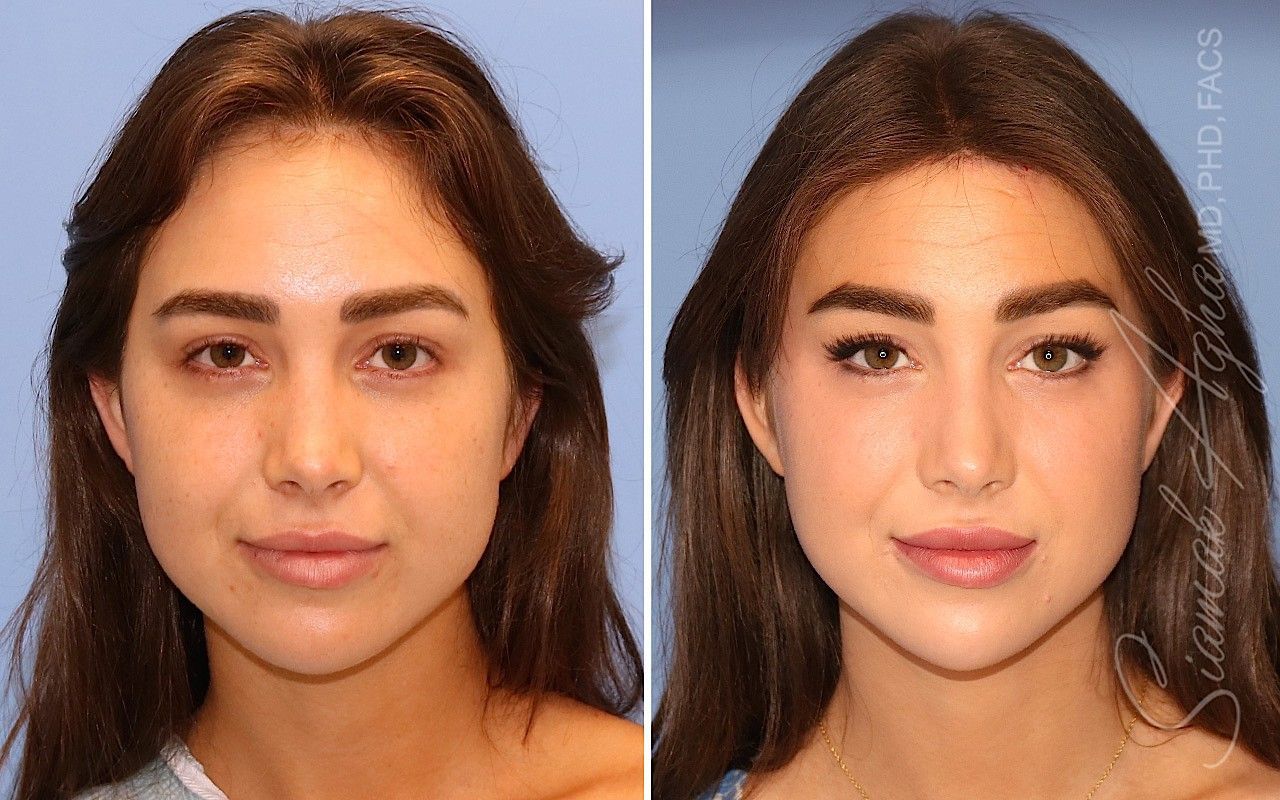 Forehead Reduction Before & After