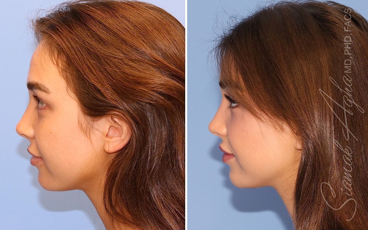 Forehead Reduction Before & After