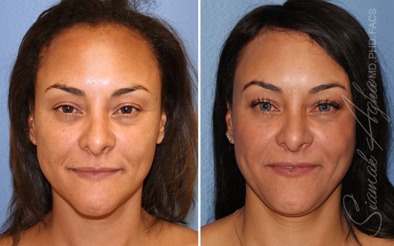 Forehead Reduction Before & After