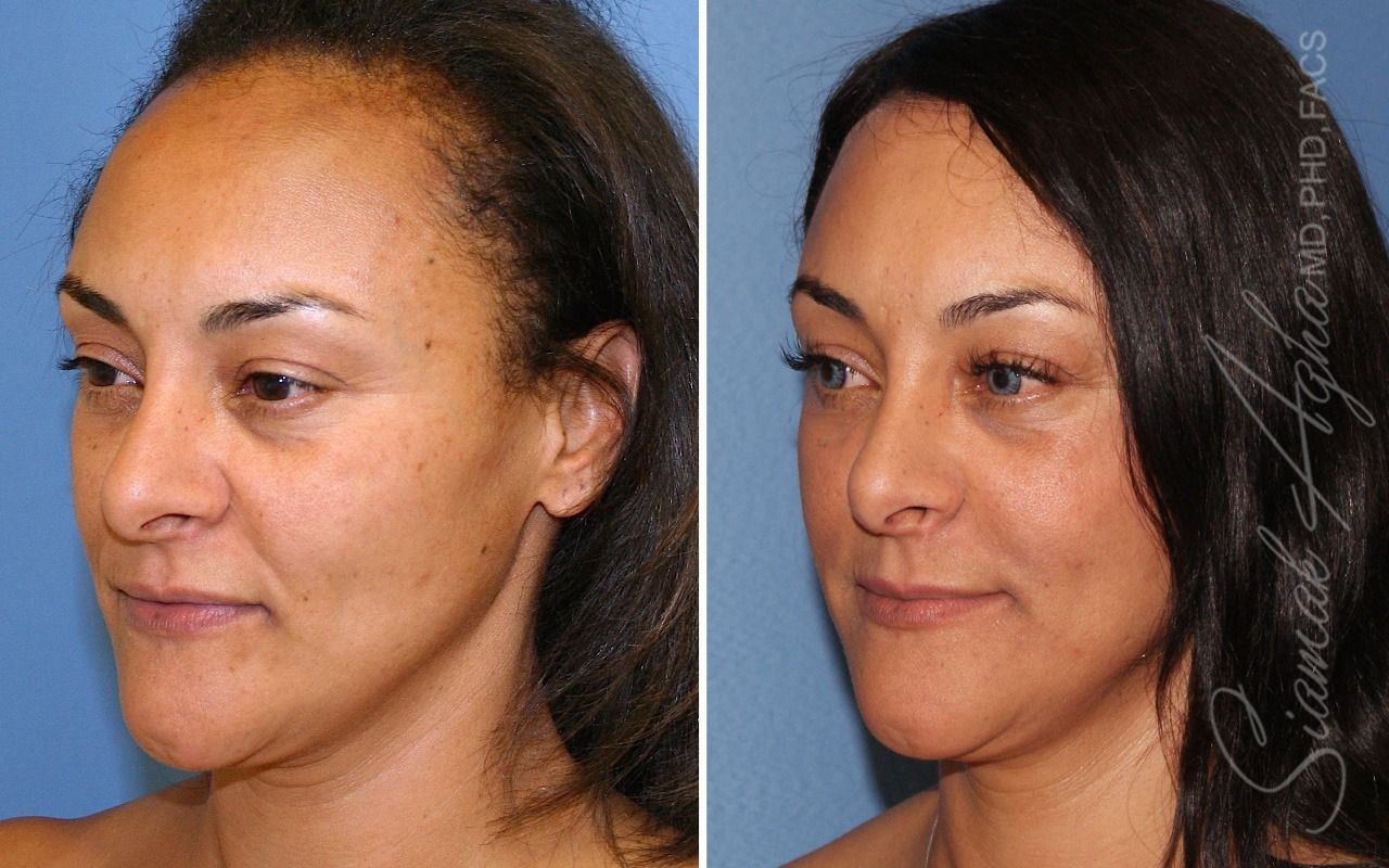 Forehead Reduction Before & After