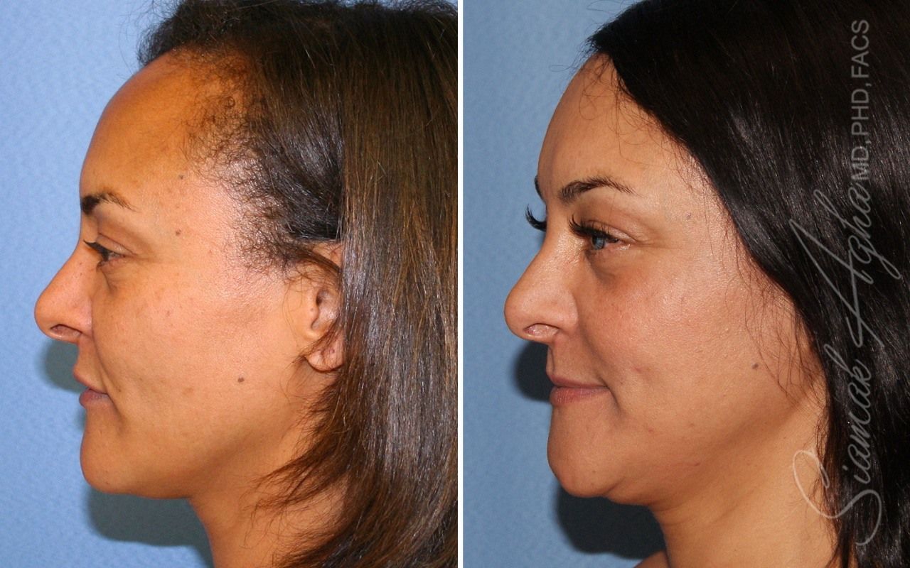 Forehead Reduction Before & After