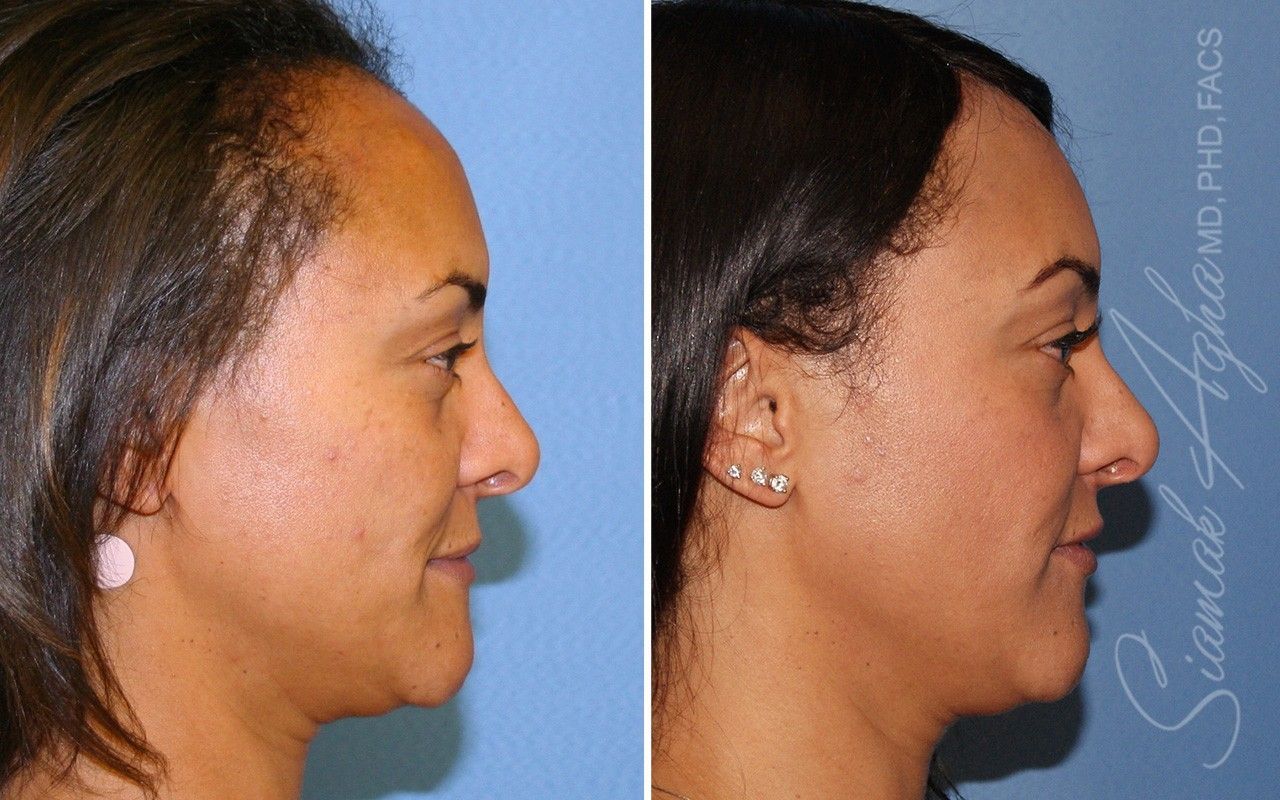 Forehead Reduction Before & After