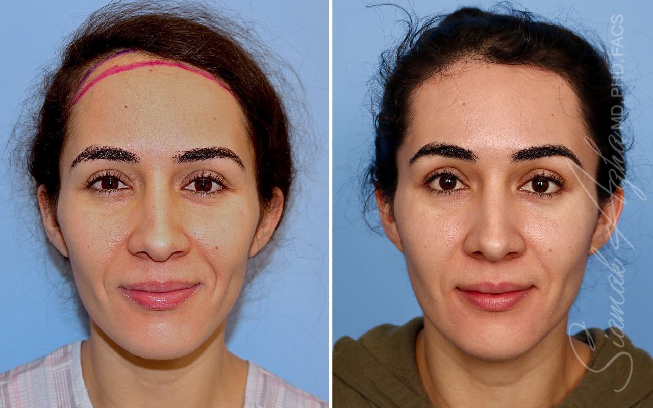 Forehead Reduction Before & After