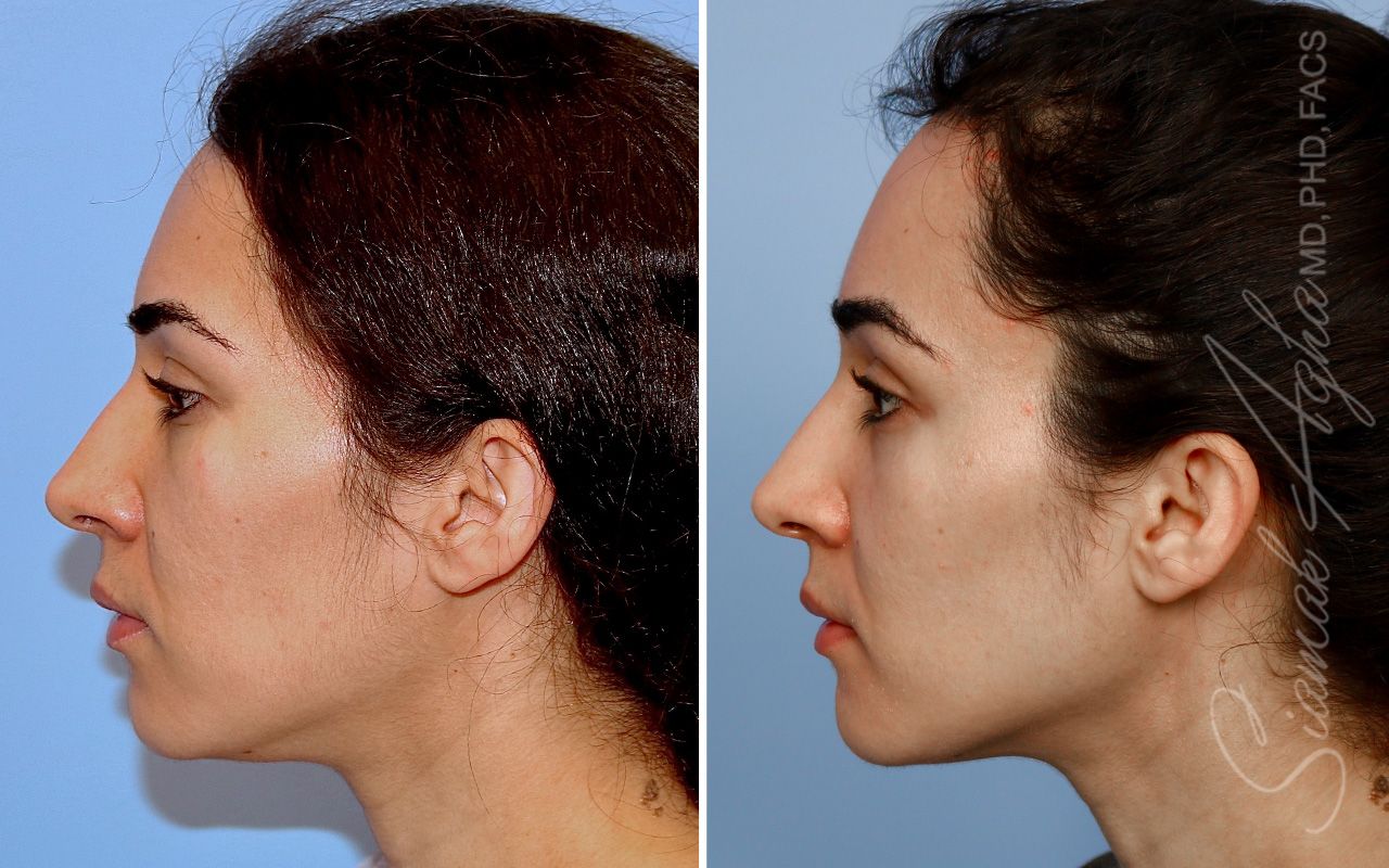 Forehead Reduction Before & After