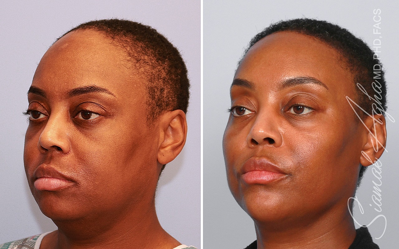 Forehead Reduction Before & After