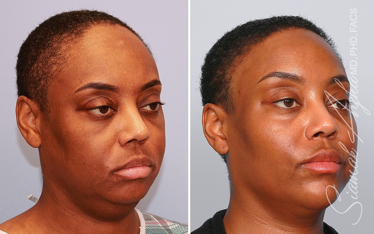 Forehead Reduction Before & After