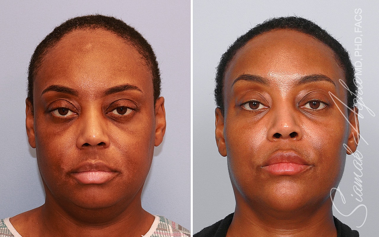 Forehead Reduction Before & After