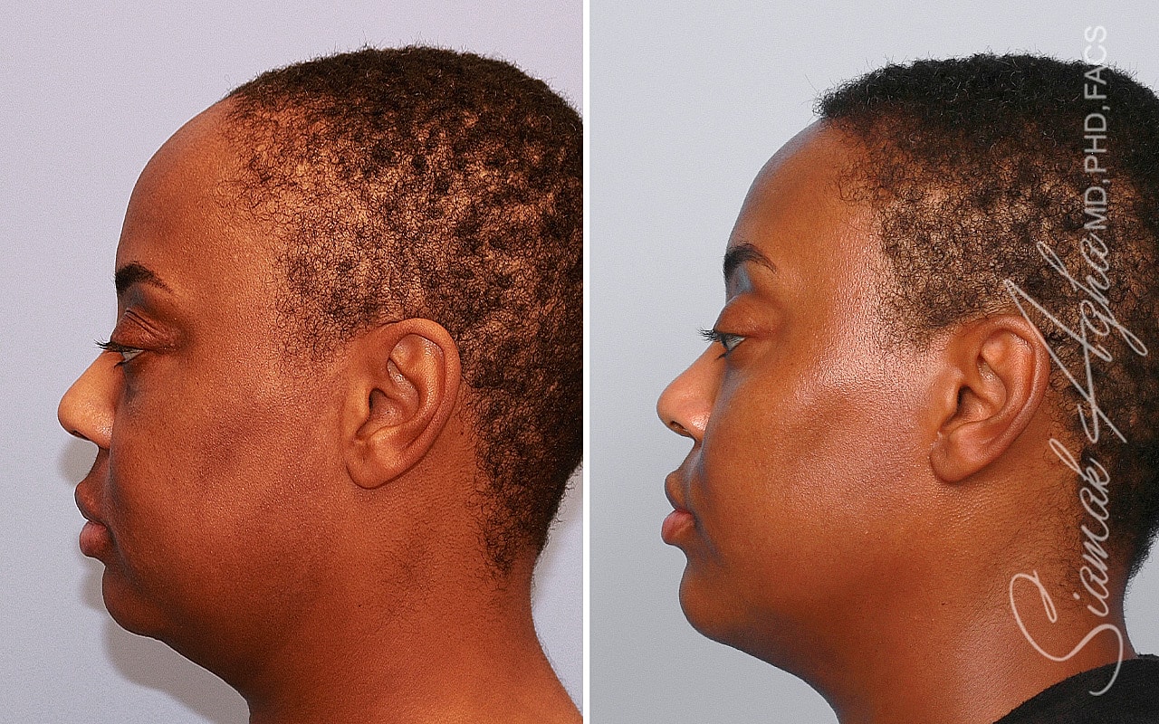 Forehead Reduction Before & After