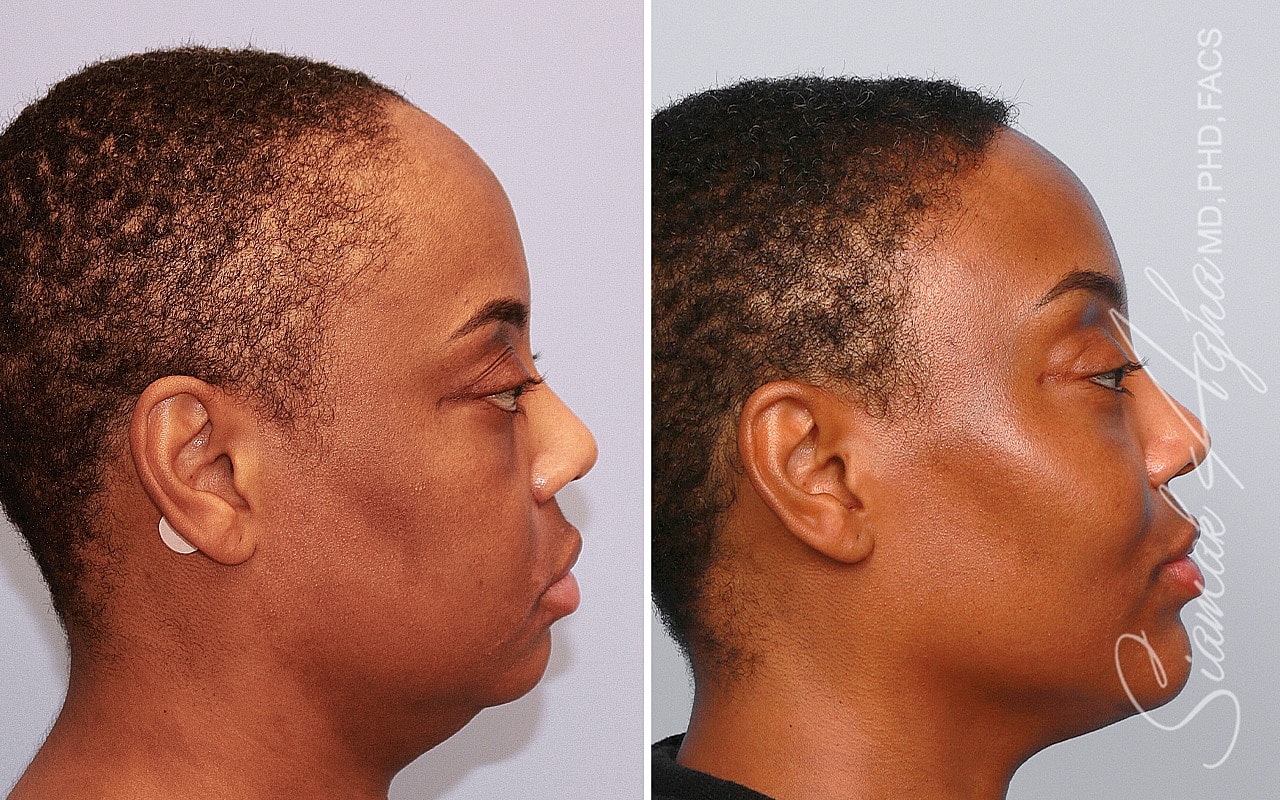 Forehead Reduction Before & After
