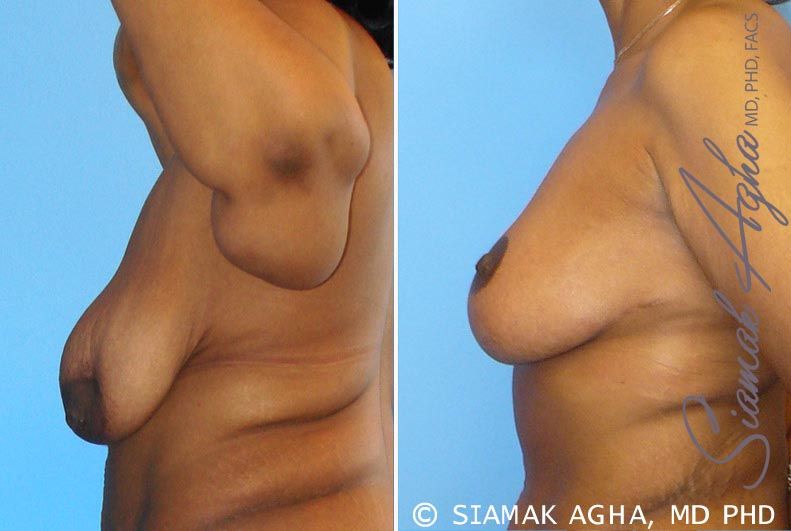 Breast Lift Before & After