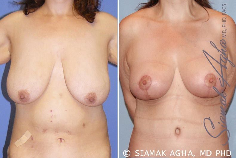 Breast Lift Before & After