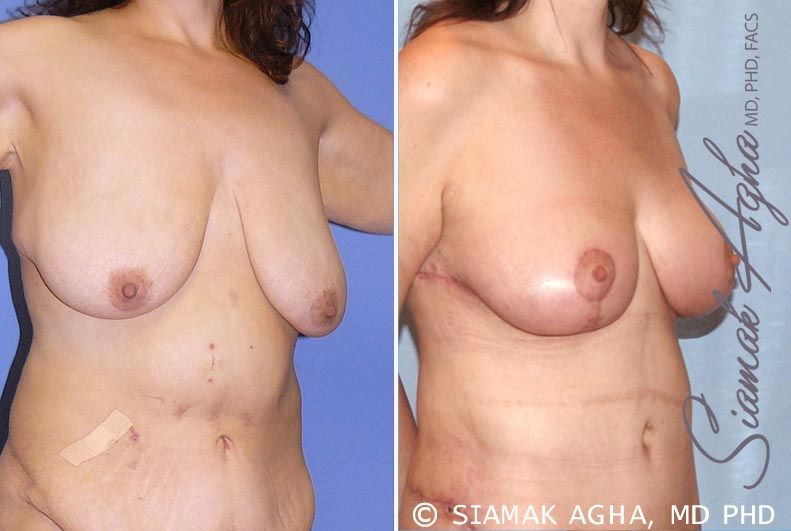 Breast Lift Before & After