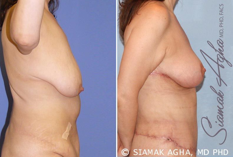 Breast Lift Before & After