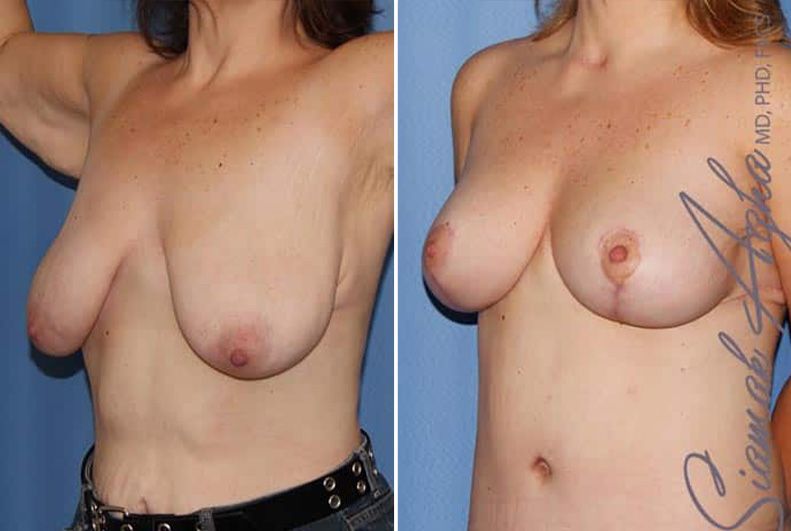 Breast Lift Before & After