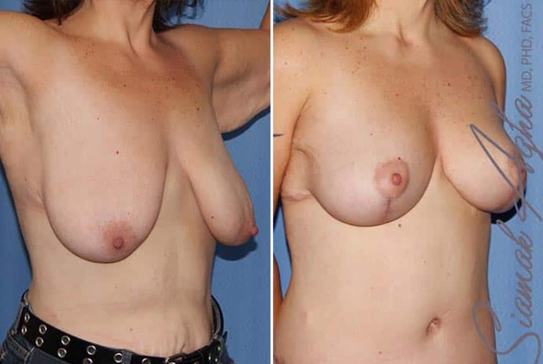 Breast Lift Before & After