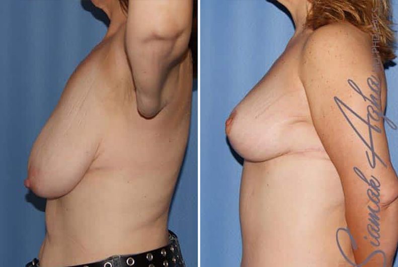 Breast Lift Before & After