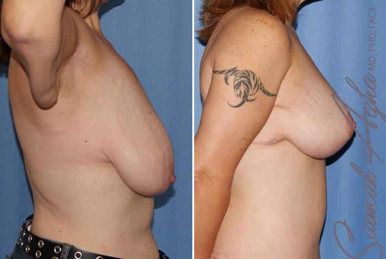 Breast Lift Before & After