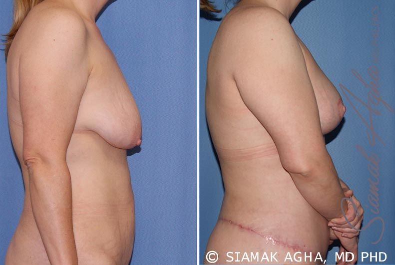 Breast Lift Before & After