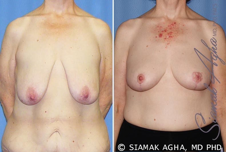 Breast Lift Before & After